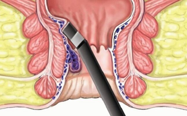 clotting of hemorrhoids in hemorrhoids